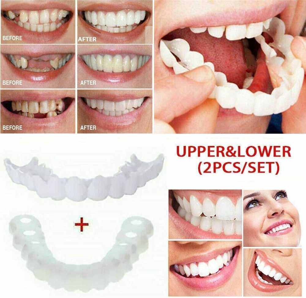 Temporary Snap-On Dentures | أسنان صناعية مؤقتة